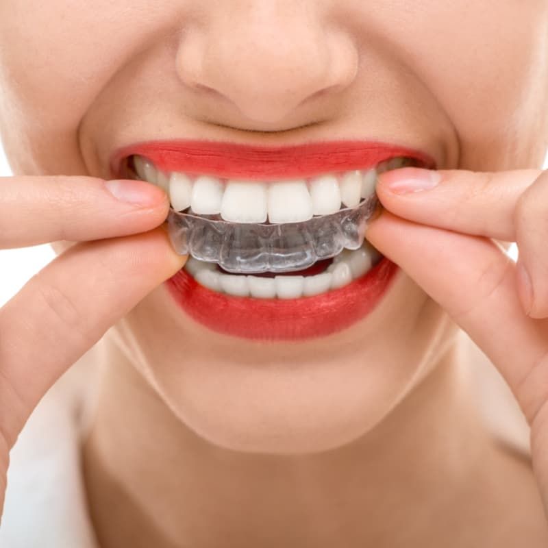 achieve a straighter smile with basalt dentistry invisalign